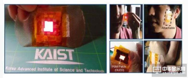 韩国研究员发明“OLED贴片”，利用光来治疗伤口